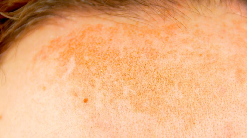 7⃣ type 2 diabetes skin symptoms that you have to know? - -