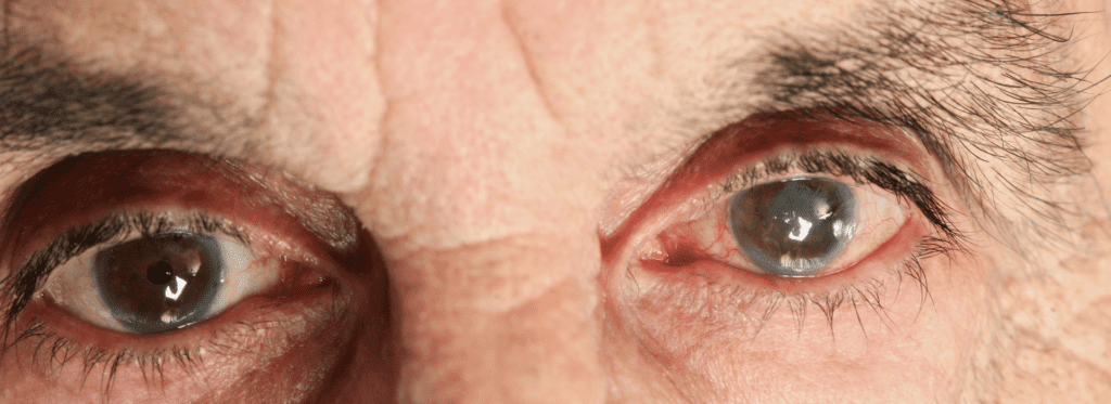 La diabetes y los ojos 🤷🏻♂️ ¿qué debo saber? - -